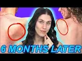 How I FINALLY Got my Body Acne to Behave