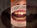 Download Lagu Veneers Process