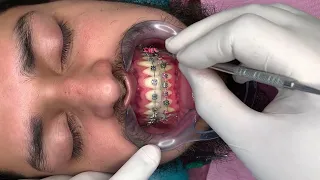 🔥Quitando Alambres y Módulos Elásticos en la Cita de los Brackets🔥