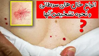 کدام خال خطرناک است 