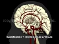 Download Lagu What Is A Stroke? - Narration and Animation by Dr. Cal Shipley, M.D.