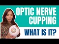 What is Optic Nerve Cupping