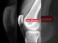 Joint Effusion of the Knee
