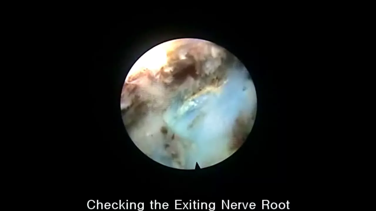 L5-S1 Herniated Disc Patient Exam & Treatment At Advanced Chiropractic Relief Ring Dinger Too. Its A. 