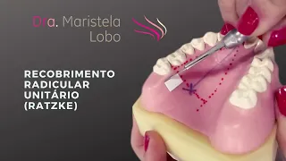 RECOBRIMENTO RADICULAR UNITÁRIO (RATZKE)