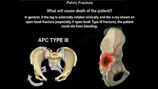 Pelvic Fractures Types  and Management