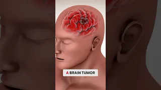 الموجات فوق الصوتية المركزة تعزز علاج أورام المخ دندنها