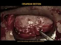 Download Lagu OPERASI CAESAR (C-Section Delivery)