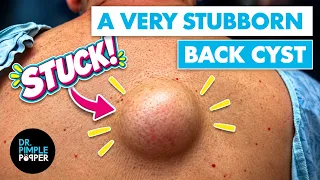 Dr. Pimple Popper vs. One VERY Stubborn Back Cyst