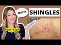 Dermatologist Explains Shingles Is it Contagious Shingles Treatments Prevention Dr Sam Ellis