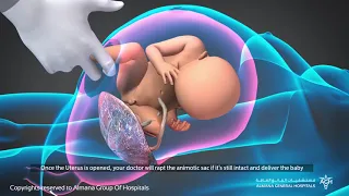 كيف تتم الولادة القيصرية و متى تكون ضرورية 