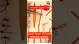 كيفية ازالة خيط الجرح Remove Suture Shorts 