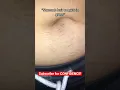 Having stomach hair is normal