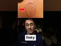 What Does Ringworm Look Like on Different Skin Tones