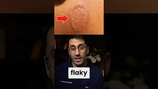 What Does Ringworm Look Like on Different Skin Tones
