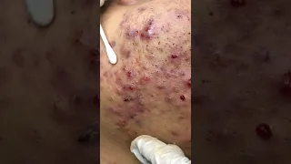 Mun thanh part 4 spa Hai Au
