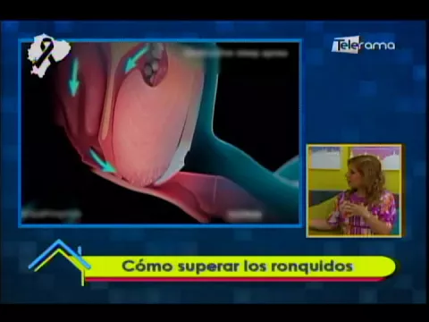 Cómo superar los ronquidos