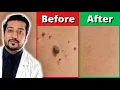 How to Rid Skin Tags FASTER 3 Easy Skin Tag Removal Steps