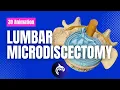 Lumbar Microdiscectomy - 3D Animation