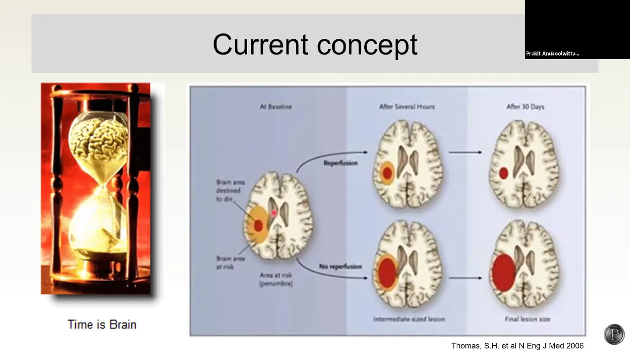 ประเมิน NIHSS ใน acute stroke