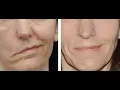 Decompression facial nerve CPT code - simplify medical coding