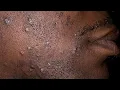 MSGT IN THE ARMY LOSES RANK AND BILLET DUE TO SHAVING PROFILE