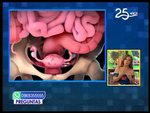 Dr. en Casa: Menstruaciones dolorosas ¿Señal de endometriosis? 