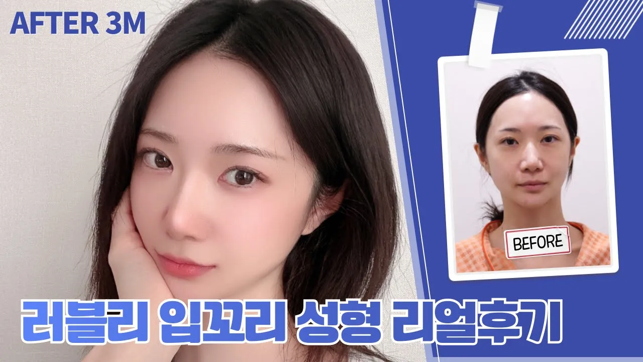 입꼬리 하나로 첫인상이 바뀐다!? I ATOP 입꼬리+입술 필러 리얼후기 😲