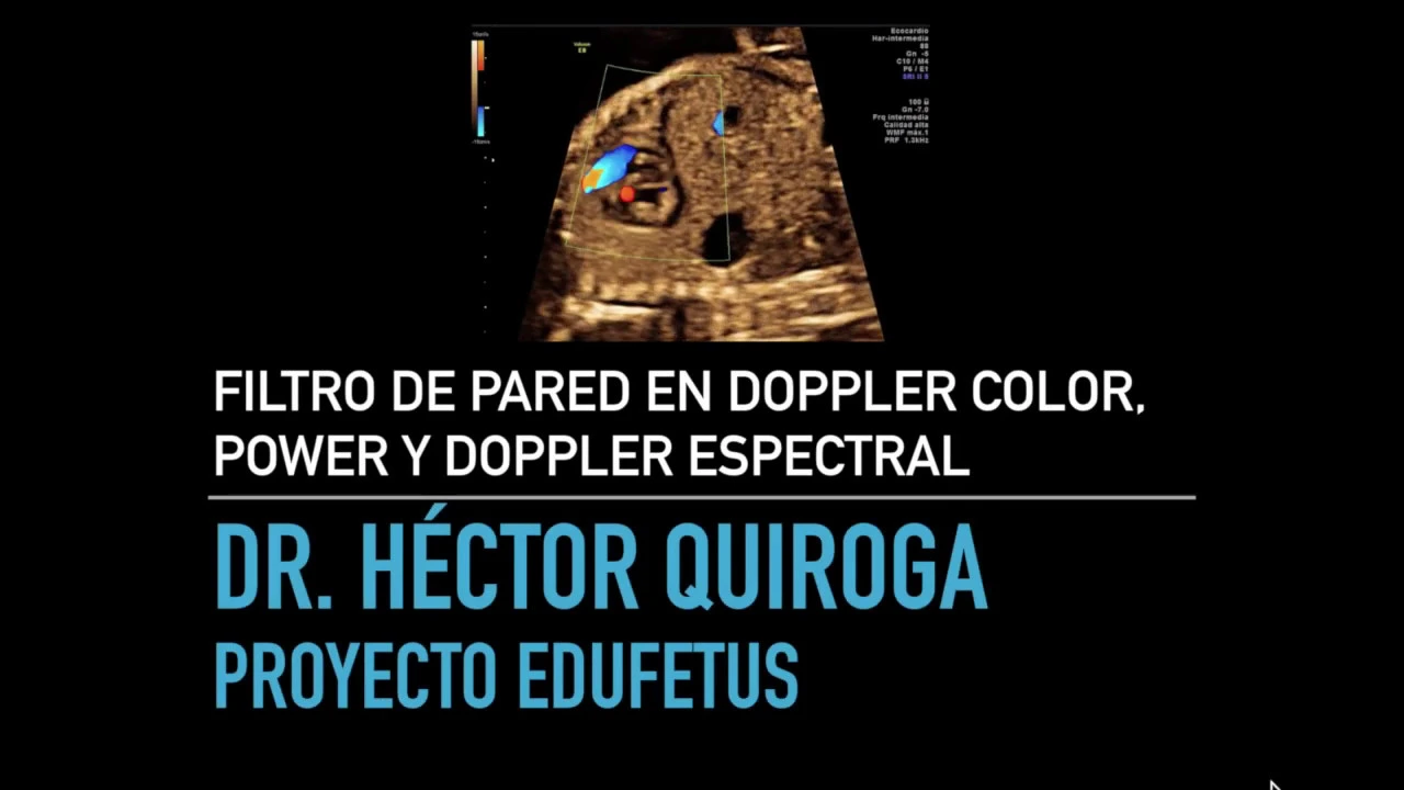 Filtro de pared en Doppler Color, Power y Doppler Espectral