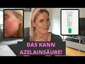 Download Lagu ROSAZEA-Serie | FOLGE 8: AZELAINSÄURE bei RÖTUNGEN \u0026 PICKELMALEN | + Produktempfehlung