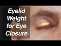 Lagu Gold or Platinum Eyelid Weight to Treat Incomplete Eye Closure in Facial Paralysis