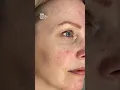 Download Lagu ROSACEA skin care TREATMENT ‼