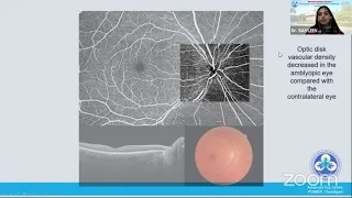 Download AIOC2021 - IC399 - Topic -  Dr  SAVLEEN KAUR -  OCT Angiography in strabismus and amblyopia –.. MP3