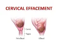 CERVICAL EFFACEMENT