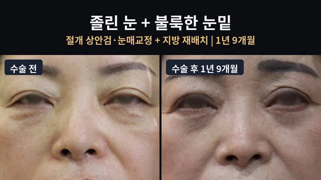 윗눈꺼풀과 아래 눈꺼풀을 함께 교정했을 때, 7개월·1년·1년 9개월 후의 변화#상안검수술 #하안검수술#눈밑지방재배치#눈썹하거상#연세자연미 #신촌성형외과