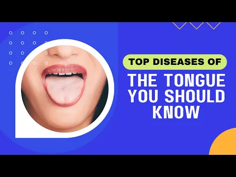 redde guld Postimpressionisme 13 Diseases Of The Tongue You Should Know