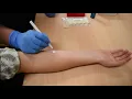 Stratum corneum tape stripping