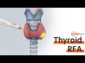 Thyroid Radiofrequency Ablation RFA Procedure - YouTube subtitle