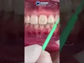 Braces at Absolute Dental Clinic