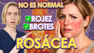 ROSÁCEA: las señales que estás ignorando en tu cara
