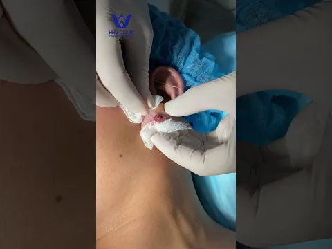 Nặn mụn nhọt ở Tai - Đau nhức sưng viêm.