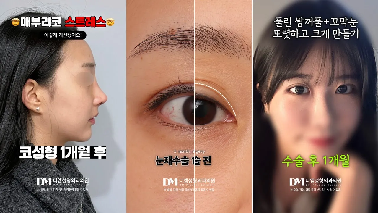 눈, 코성형 맛집은 역시 디엠👏 | 성형 쇼츠 모음▶️