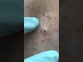 Download Lagu GIANT Blackhead removed from the Back! w/ Dr. Pimple Popper #shorts