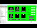 Liver Cancer Detection Using Image Processing
