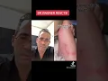 LONGEST INGROWN HAIR