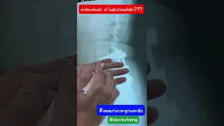  ทำไมคนที่เคยผ่าตัดกระดูกสันหลังแล้วถึงมีอาการปวดร้าวลงขา และเกิดปัญหาใหม่ที่ช่องระหว่างหมอนรองกระดูก 