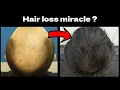 Lagu This Treatment Will Revolutionize Hair Loss Management in 2026