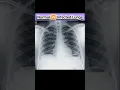 Download Lagu Normal 🆚 Infected Lungs#gamcamedical