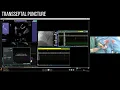 Download Lagu Full Procedure Cardiac Ablation, #1 of 6 of Master Class in Supreme Efficiency in Robotic EP