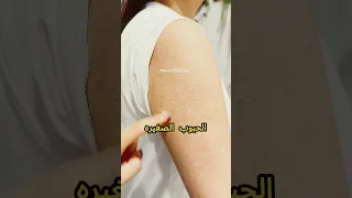 كيف تتخلص من جلد الوزة  أسباب وحلول بسيطة مع سؤال مهم لكم  دندنها